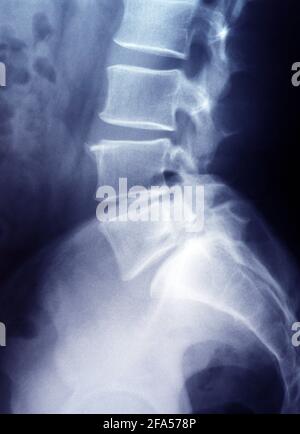 Röntgenbild der Lendenwirbelsäule und des Beckens Stockfoto