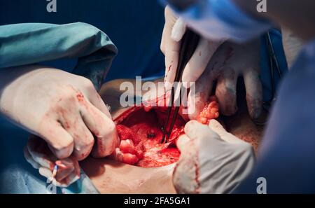 Nahaufnahme von medizinischen Mitarbeitern Hand in sterilen Handschuhen bei der Abdominoplastik-Operation. Plastischer Chirurg und Assistent mit medizinischen Instrumenten. Konzept der Medizin, Bauchstraffung und plastische Chirurgie. Stockfoto