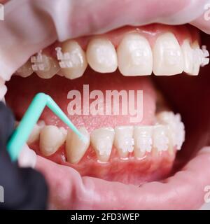 Makroaufnahme der Hand des Zahnarztes, Bürsten der unteren Zähne mit einem winzigen grünen Pinsel, bevor die nächste Halterung angebracht wird. Zahnärztliche Verfahren. Vorderansicht. Konzept der Mundhygiene Stockfoto