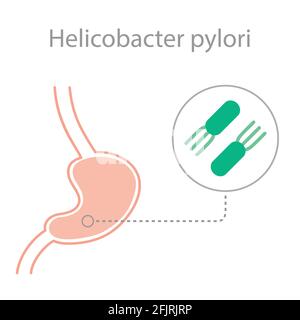 helicobacter pylori-Bakterienerkrankung. Humaner Magen Stock Vektor