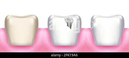 Zahnprobleme. Karies, Zahnerkrankungen, Infektionen, Karies und Zerstörung des Zahnschmelzes. Professionelle Reinigung oder Aufhellung. Realistische 3d-Stomatologie Stock Vektor