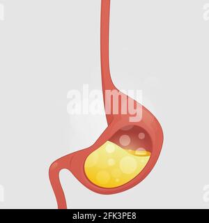 Gastroösophageale Refluxkrankheit, saurer Reflux, Sodbrennen und GERD Infografik mit medizinischer Illustration auf grauem Hintergrund, Cartoon und Vektor Stock Vektor