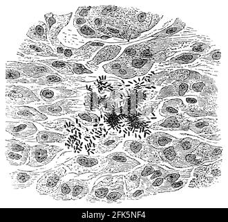 Typhus-Bazillen. Aus der Milz geschnitten. Illustration des 19. Jahrhunderts. Deutschland. Weißer Hintergrund. Stockfoto