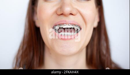 Die Frau lächelt und zeigt ihre weißen Zähne mit Zahnspangen. Sogar Zähne mit Zahnspangen. Das Konzept eines Zahnarztes und eines Kieferorthopäden. Stockfoto