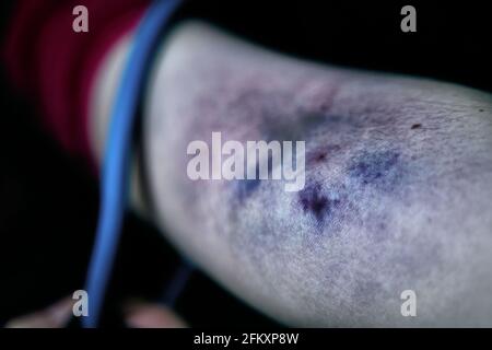 Nahaufnahme des großen Bluthämatoms. Der Arm der Frau ist durch die Einnahme von intravenösem Betäubungsmittel verletzt. Drogenabhängiger zieht das Tourniquet am Arm. Konzept von Verzweiflung und Depression. Sucht nach illegalen Substanzen. Stockfoto