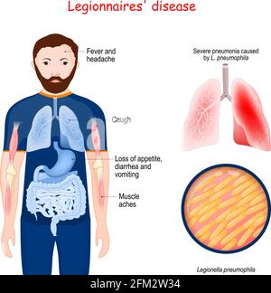 Legionärskrankheit. Atypische Lungenentzündung, verursacht durch Legionellen-Bakterien. Anzeichen und Symptome einer Krankheit. Nahaufnahme der Lunge mit schwerer Lungenentzündung Stock Vektor