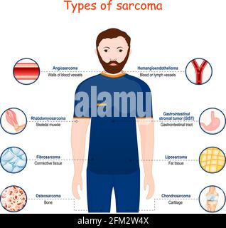 Sarkom. Arten eines bösartigen Tumors. Krebs, der aus transformierten Zellen des Bindegewebes, Knochen, Knorpels, Fettes und Gefäßgewebes entsteht. Vektor Stock Vektor