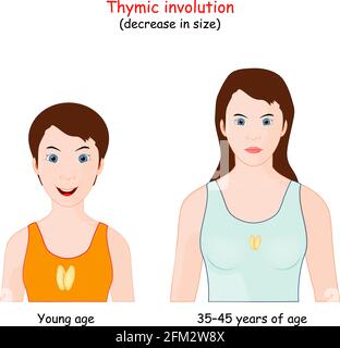 Thymian-Involution. Abnahme der Thymusgröße mit dem Alter. Vergleich der Größen lymphoides Organ des Immunsystems bei Mädchen und erwachsenen Frauen. Vektor-Illus Stock Vektor