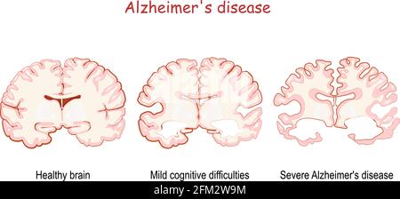 Alzheimer ist eine neurodegenerative Erkrankung. Demenz. Vergleich und Unterschied zwischen gesundem Gehirn, schwerer Alzheimer-Krankheit und mildem kognitiven Stock Vektor