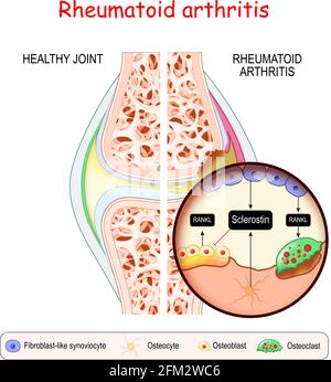 Rheumatoide Arthritis (RA). Nahaufnahme von Knochenzellen (Osteocyte, Osteoblast, Osteoklast und Fibroblast-ähnliche Synoviozyten), die RANKL ausschütten Stock Vektor