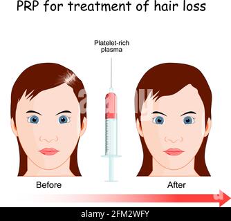 Thrombozytenreiches Plasma. PRP-Verfahren zur Behandlung von Haarausfall. Frau mit Alopezie vor und nach der Injektion. Stock Vektor