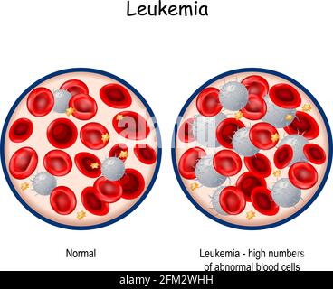 Leukämie. Vergleich und Unterschied zwischen Blut gesunder Menschen und Blutkrebs. Nahaufnahme des Blutgefäßes mit Erythrozyten, Blutplättchen Stock Vektor