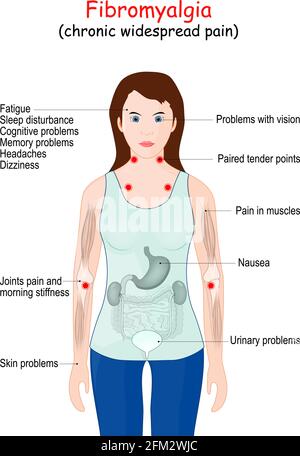 Fibromyalgie (FM). Anzeichen und Symptome einer Krankheit. Frau Silhouette mit inneren Organen. Vektorgrafik Stock Vektor