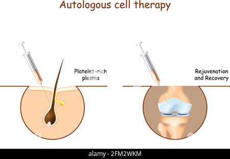 Thrombozytenreiches Plasma. Autologe Zelltherapie von Haaren und Knie zur Rejuvenation und Erholung. Infografiken für den medizinischen Gebrauch. vektordarstellung. Stock Vektor