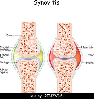 Synovitis. Nahaufnahme. Vergleich und Unterschied zwischen einem gesunden Gelenk und einem Gelenk mit Entzündung der Synovialmembran. Anzeichen und Symptome Stock Vektor