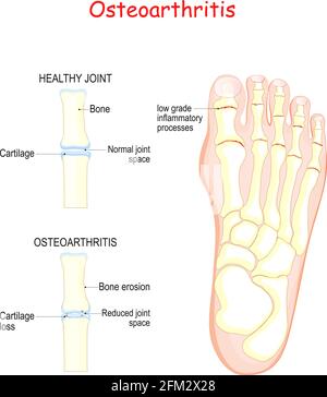 Osteoarthritis. Vergleich gesunde Gelenk- und Entzündungsgelenk mit Knochenerosion und Knorpelverlust. Menschlicher Fuß. vektordarstellung Stock Vektor