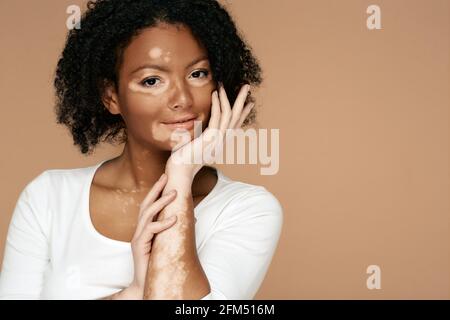 Junge Frau zeigt ihre Hautflecken an ihren Händen und Gesicht mit Vitiligo Stockfoto