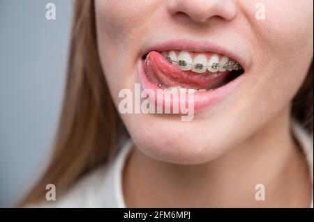 Nahaufnahme des Lächelns einer jungen Frau mit Metallspangen an den Zähnen. Bisskorrektur Stockfoto