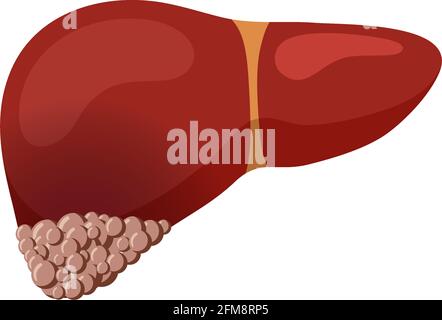 Ungesunder Leberkrebs. Konzept zur Zerstörung von humanen exokrinen Gland-Organen. Flache Vektorgrafik Onkologie Stock Vektor