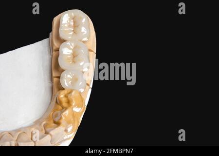 Keramik-Zahnbrücke für Molaren und Prämolaren. Auf schwarzem Hintergrund. Kopierraum Stockfoto