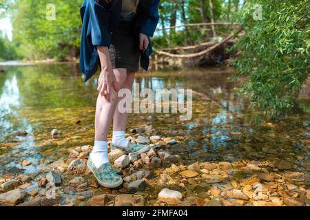 Eine junge Frau, die ihr Bein aufgrund von Insektenstichen in der Natur zerkratzt. Bein mit einem Ausschlag bedeckt. Im Hintergrund Bäume und Fluss. Insektenschutzkonzept. Stockfoto