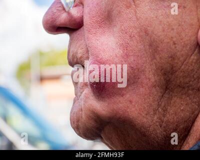 Abszess auf der Seite eines mans-Gesichts Stockfoto