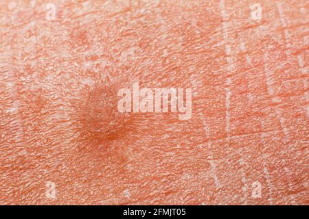 Menschliche Hautstruktur. Flach Warze auf der Haut Mikro-Foto. Nahaufnahme. Stockfoto