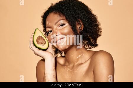 Positive afroamerikanische Frau mit Vitiligo-Krankheit hält Avocado in der Nähe ihres Gesichts. Kosmetik mit Avocado für pigmentierte Haut Stockfoto