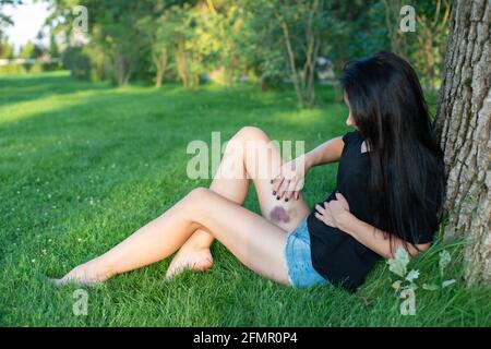 Eine junge Frau mit einem großen violetten Bluterguss am Bein sitzt im Park auf dem Gras. Posttraumatisches Hämatom. Konzept der häuslichen Gewalt. Weich selektiv Stockfoto