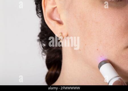 Behandlung und Entfernung von entzündeten roten Akne und Falten aus den Wangen des Gesichts des Mädchens. Modernes Verfahren zur Laserreinigung der Gesichtshaut. Kopie en Stockfoto