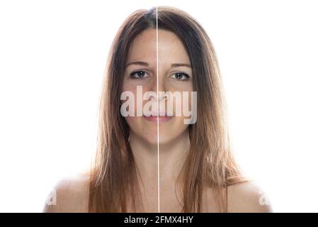 Frau Gesicht vor und nach Akne-Behandlung Verfahren Stockfoto