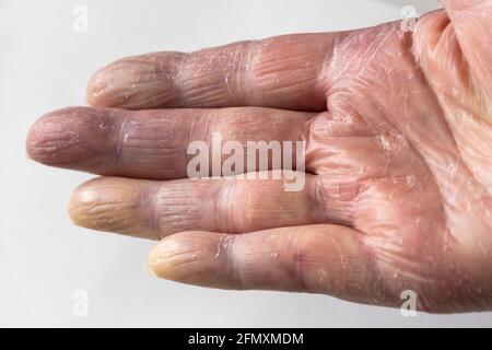 Ältere Dame Hand leiden mit Kreislaufproblemen der blauen und gelben Farbe aufgrund von gesundheitlichen Komplikationen sowie konsequente Nutzung von heißem Wasser. Stockfoto