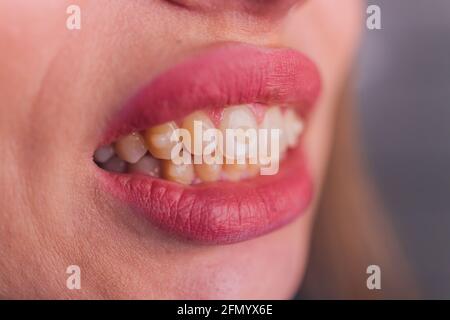 Brasket-System in einem Mädchen lächelnd Mund, Makrofotografie der Zähne. Großes Gesicht und bemalte Lippen. Zahnspangen an den Zähnen eines lächelnden Mädchens Stockfoto