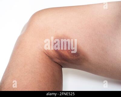 Blaue Flecken auf der Haut am Oberschenkel auf weißem Hintergrund. Nahaufnahme eines großen Hämatoms am rechten Bein. Stockfoto