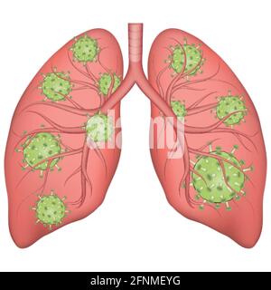 Vektor medizinische Illustration der realistischen menschlichen Lungen, die durch Coronavirus beeinflußt werden. Konzept für Lungenerkrankungen. Stock Vektor