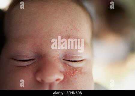 Neonatale Akne auf einem Babygesicht Stockfoto