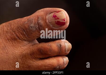 Nahaufnahme der Beine Finger einer Frau mit chronischer Psoriasis auf schwarzem Hintergrund. Nahaufnahme von Hautausschlag und Schuppenbildung auf der Haut des Patienten. Derm Stockfoto