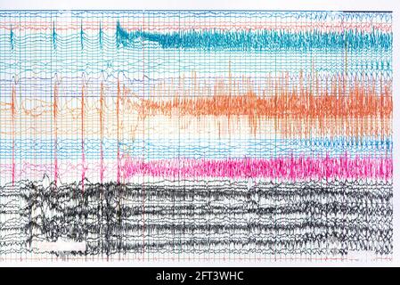 Foto der Aufzeichnung des Iktalen EEG während eines Anfalls. Anfallswellen, die die Ausbreitung hoher Amplituden und Frequenzwellen zeigen. Stockfoto