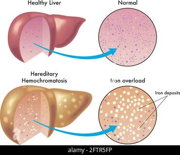 Die medizinische Illustration zeigt den Unterschied zwischen einer gesunden Leber und einer mit erblich bedingter Hämochromatose, mit vergrößerten Details und Anmerkungen. Stock Vektor