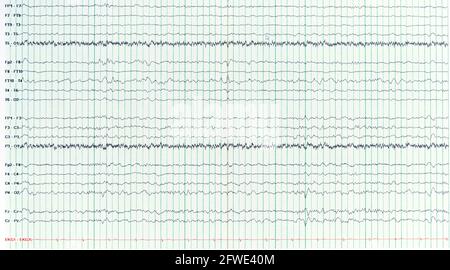 Fotografie der menschlichen Elektroenzephalograhie eines epileptischen Patienten, die eine scharfe Welle ohne Anfall oder interiktales EEG zeigt. Stockfoto