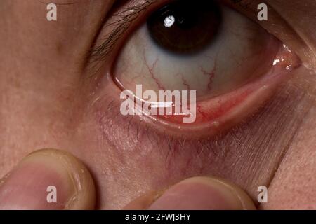 Augenstile Nahaufnahme Augeninfektion Eiter. Chalazion-Infektion durch verstopfte Haarfollikel im Augenlid. Stockfoto