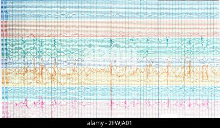 Aufnahme von Hirnwellen eines epileptischen Patienten, die eine scharfe Welle ohne Anfall oder interikales EEG zeigen. Stockfoto