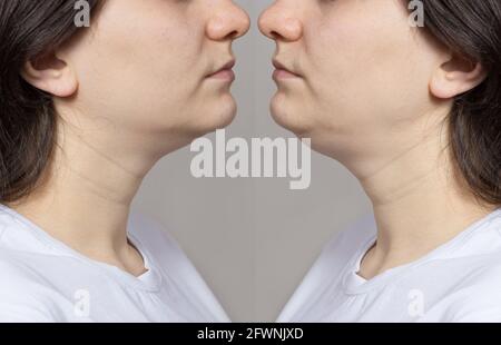 Die Frau hat ein Doppelkinn. Kinn umformen, Fett entfernen, heben. Collage-Vergleich vor und nach der Behandlung. Stockfoto