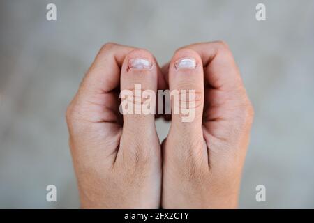 Nahaufnahme Detail von zwei Händen zusammen mit Daumen mit Weiß und Nägel gebissen Stockfoto