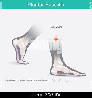 Plantare Fasziitis. Illustration menschliche Fußanatomie erklären auf Symptom plantare Fasziitis. Stockfoto