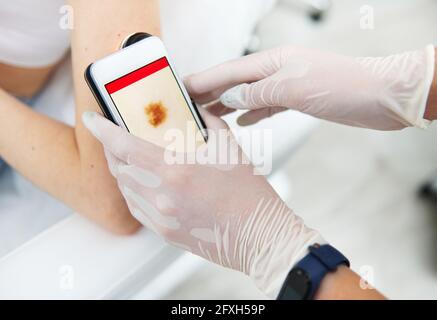 Nahaufnahme der Hand eines Arztes in medizinischen Handschuhen, die ein Dermoskop halten und Maulwürfe am Arm des Patienten untersuchen. Krebs Früherkennung und Prävention con Stockfoto