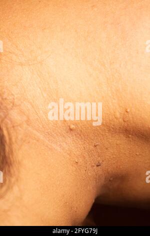 Nahaufnahme der Haut-Tags auf Hals Frau Haut.Nahaufnahme der Warze. Stockfoto