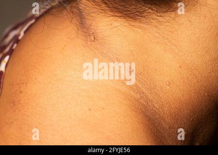 Nahaufnahme der Haut-Tags auf Hals Frau Haut.Nahaufnahme der Warze. Stockfoto