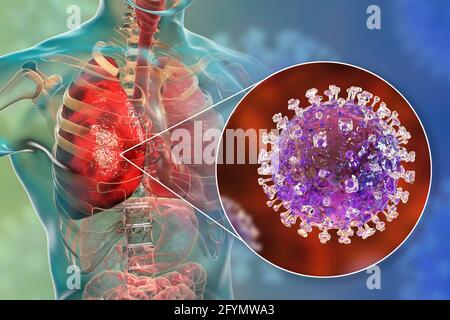 Nipah-Virus in der Lunge, Illustration Stockfoto