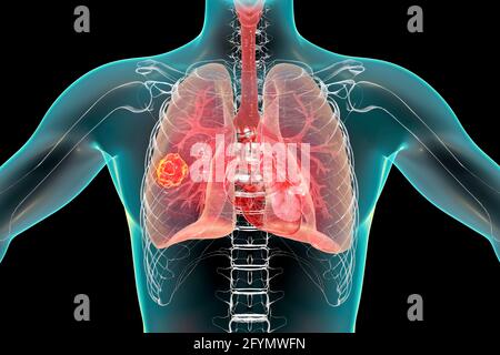 Pulmonale Mukormykose, Illustration Stockfoto